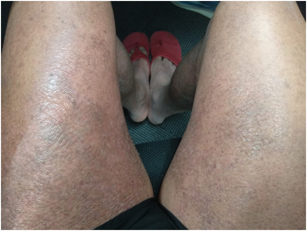 dry patches on thigh